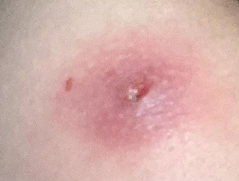 My asscheek hurts (help)