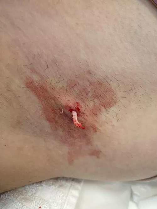 Armpit Cyst Big Daddy & Baby Pop