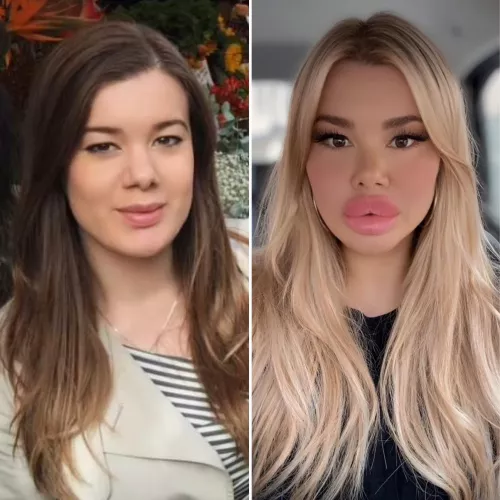 Before after lip fillers