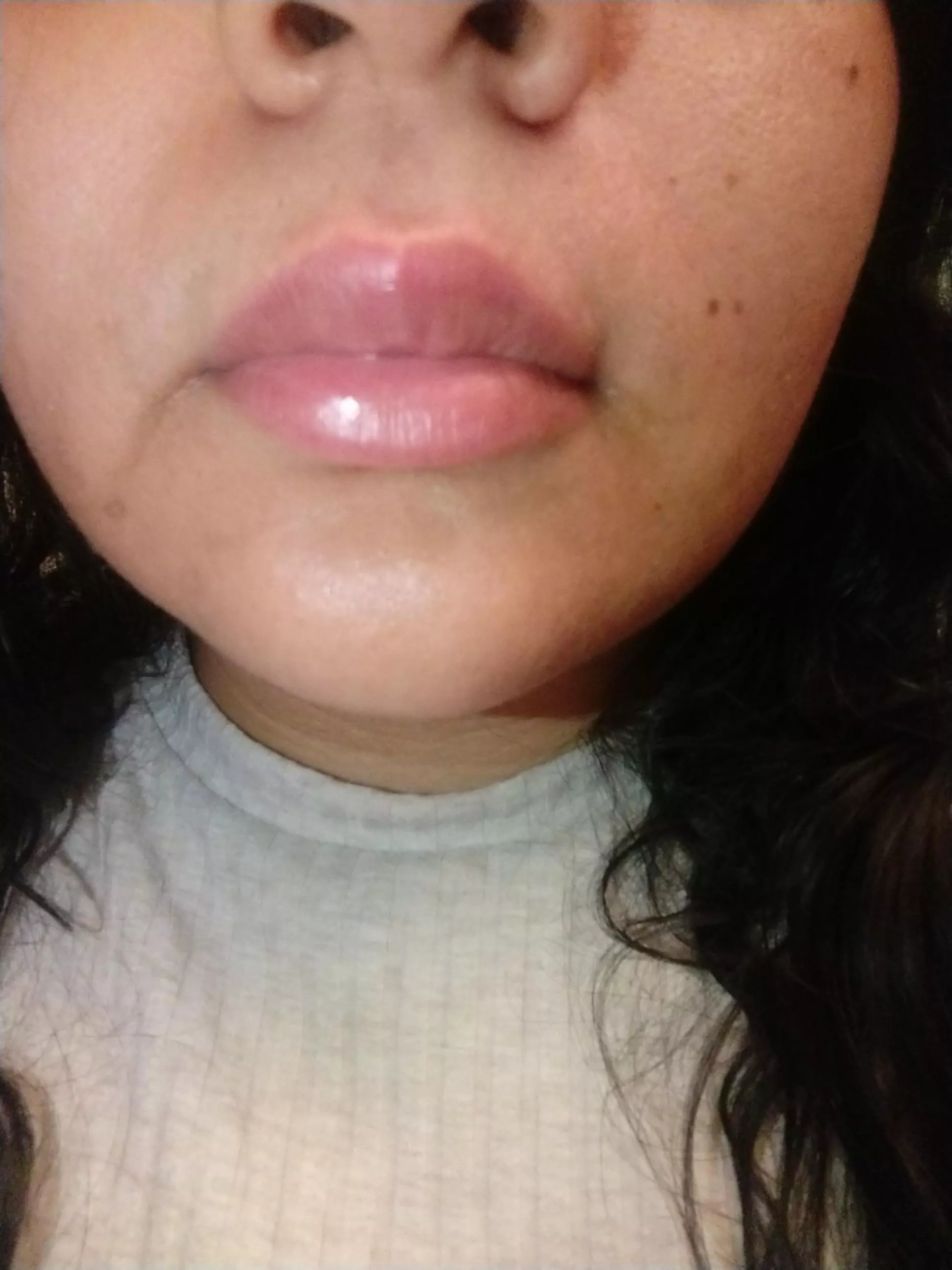 My upper lip started feeling itchy all of a sudden and realized that my cupids bow is hard. I can feel a small hard lump and kinda scared. Should I be worried?