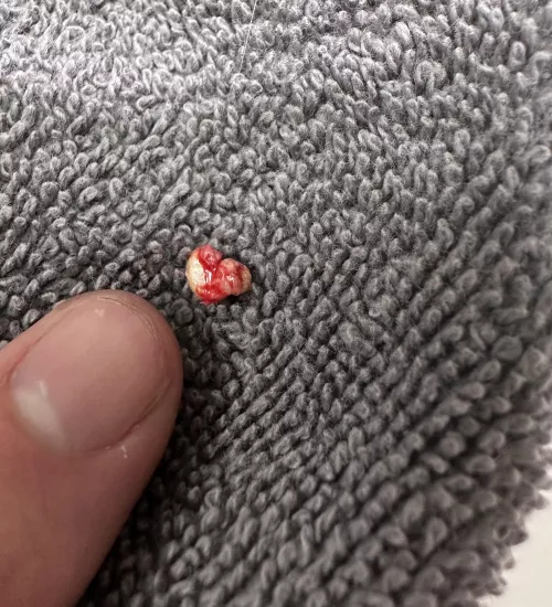 What did I just squeeze out of the top of my lip?