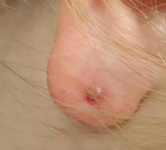 A student told me her ear hurt and when I touched the lobe to look at it an abscess burst all over me.