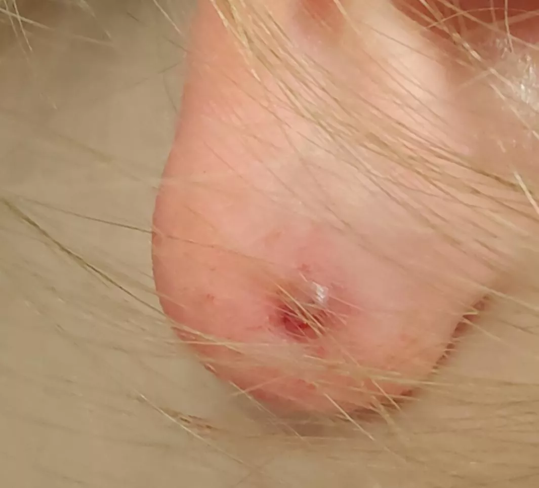 A student told me her ear hurt and when I touched the lobe to look at it an abscess burst all over me.