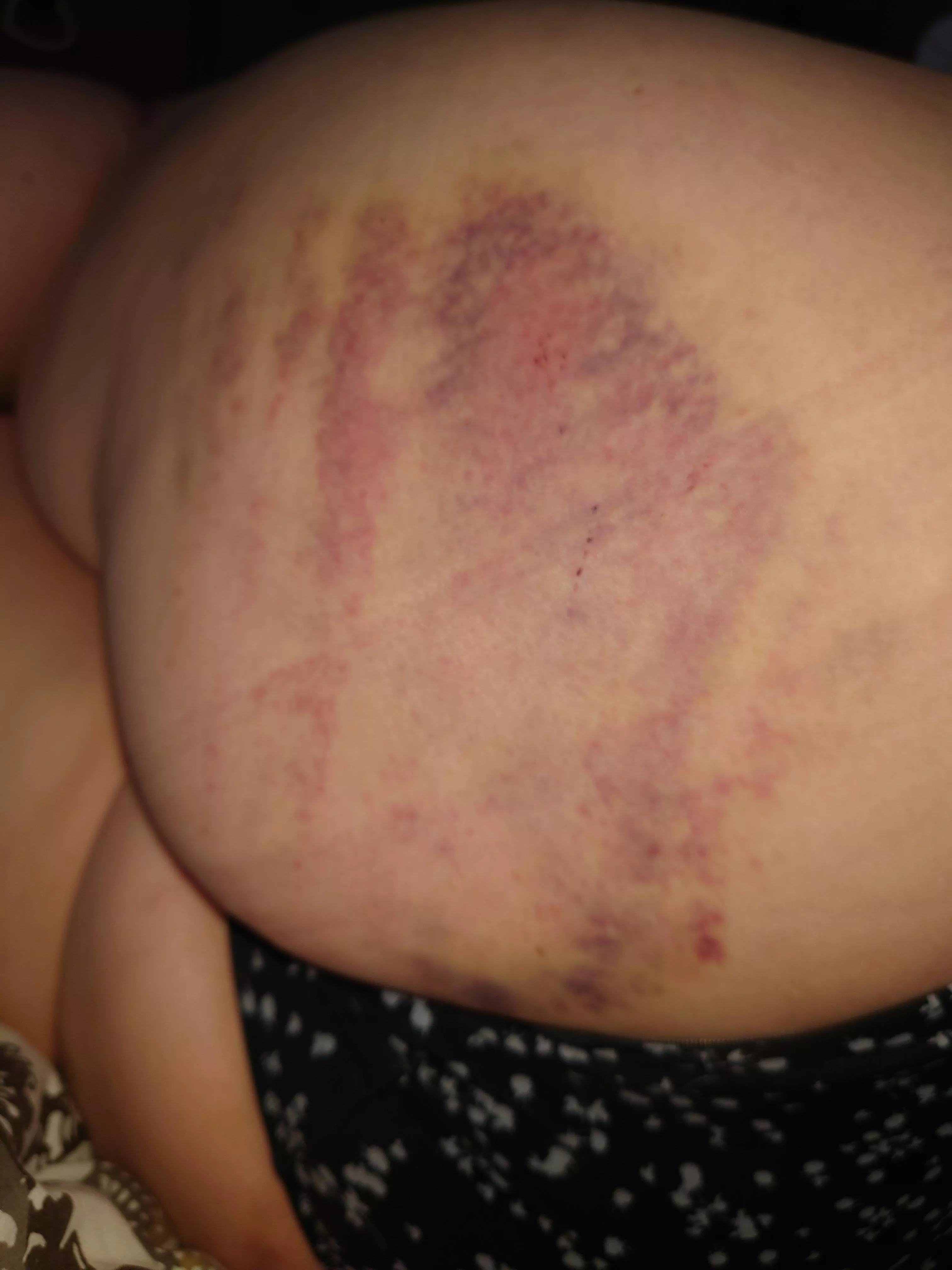 Tag 3 nach der Spanking Session