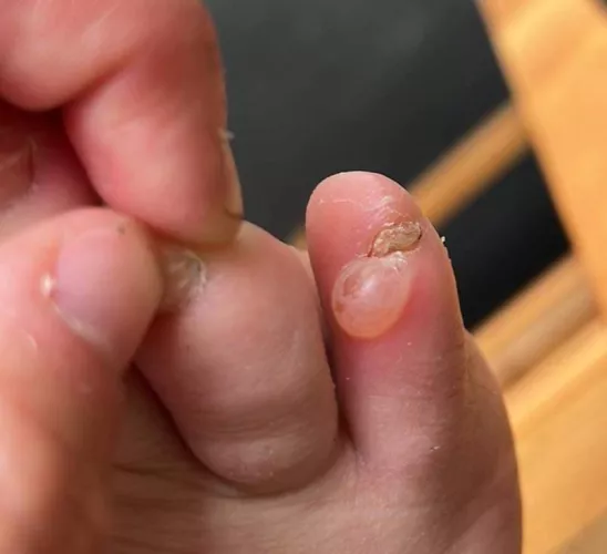 This blister on my little toe caused by my shoes being too tight and the constant friction of the toe against the edge. Forbidden grape.