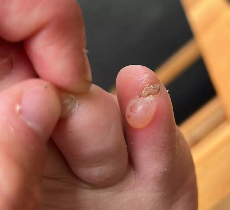 This blister on my little toe caused by my shoes being too tight and the constant friction of the toe against the edge. Forbidden grape.