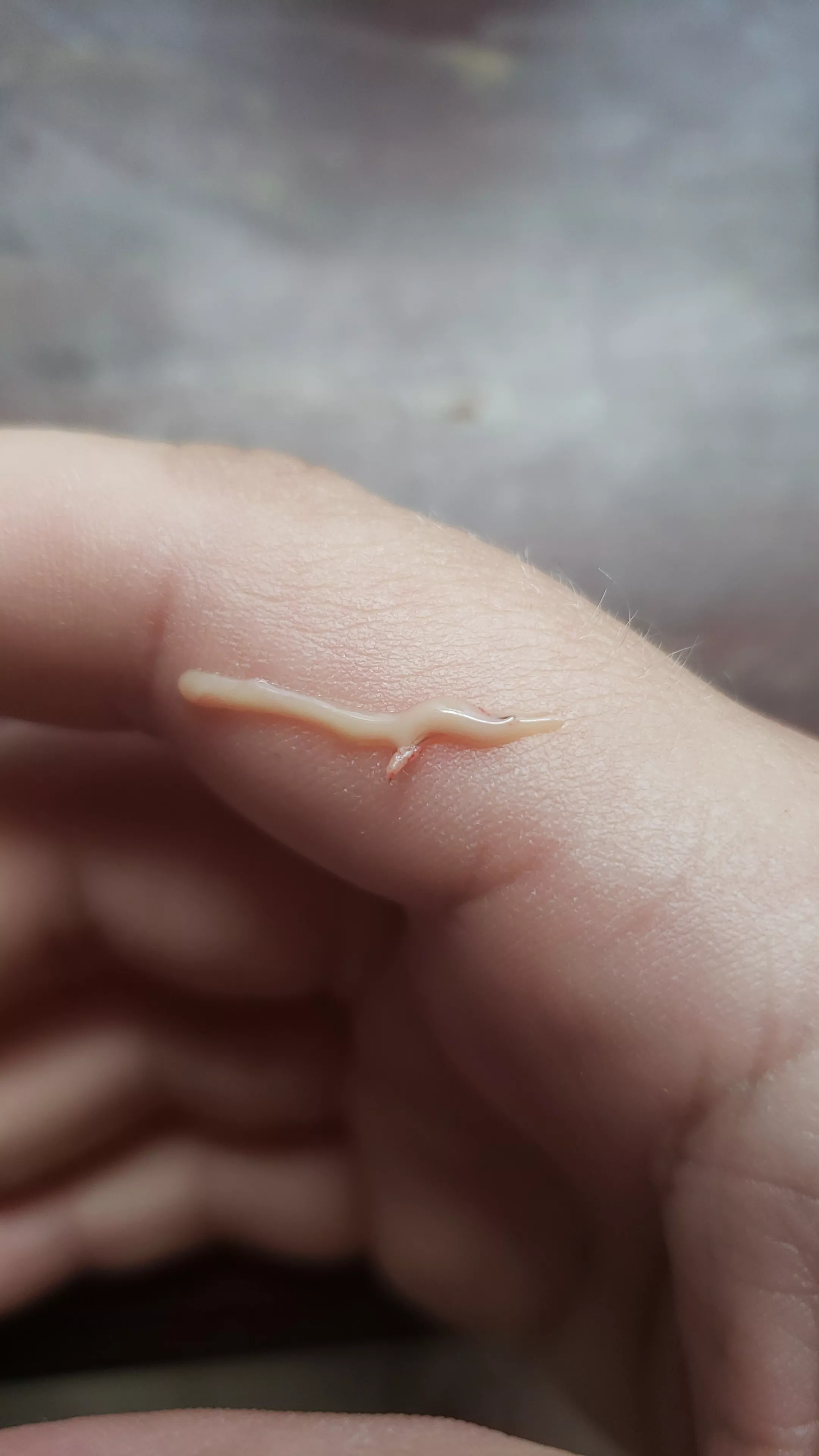 Aftermath of an ingrown hair boil