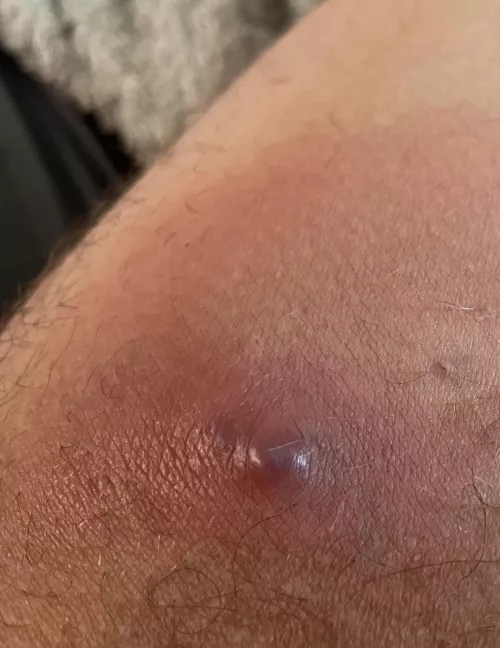 Inner thigh, ouch, need to pop!