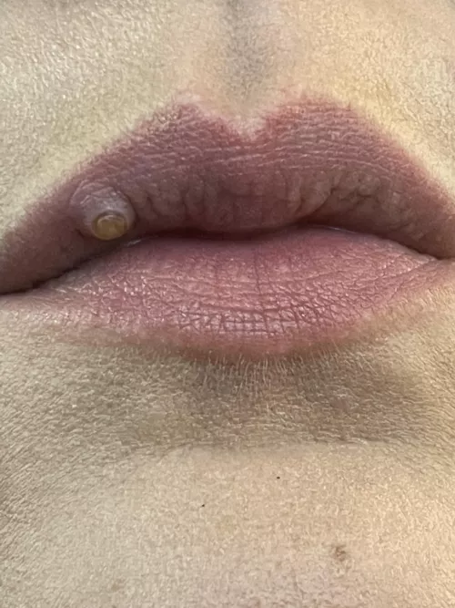 Is this a Mucocele Cyst?