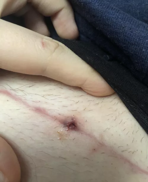 My inflamed C-Section wound, wish I would have recorded it, but I didn’t see it until it popped 🫣