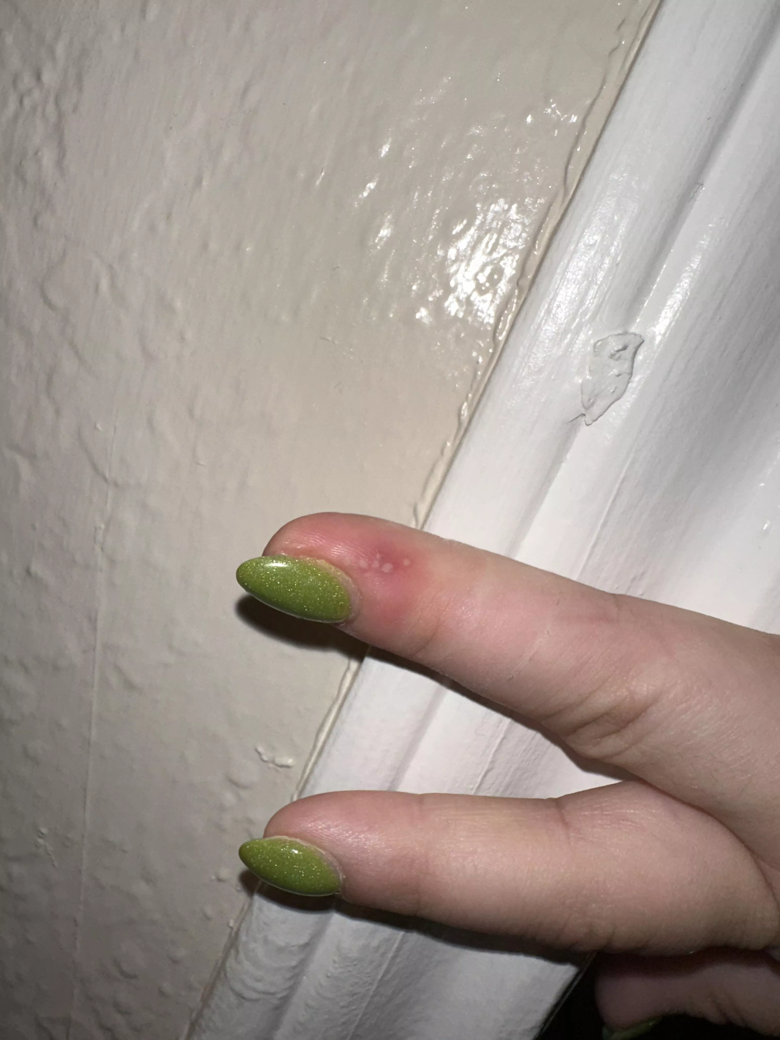 More herpetic Whitlow