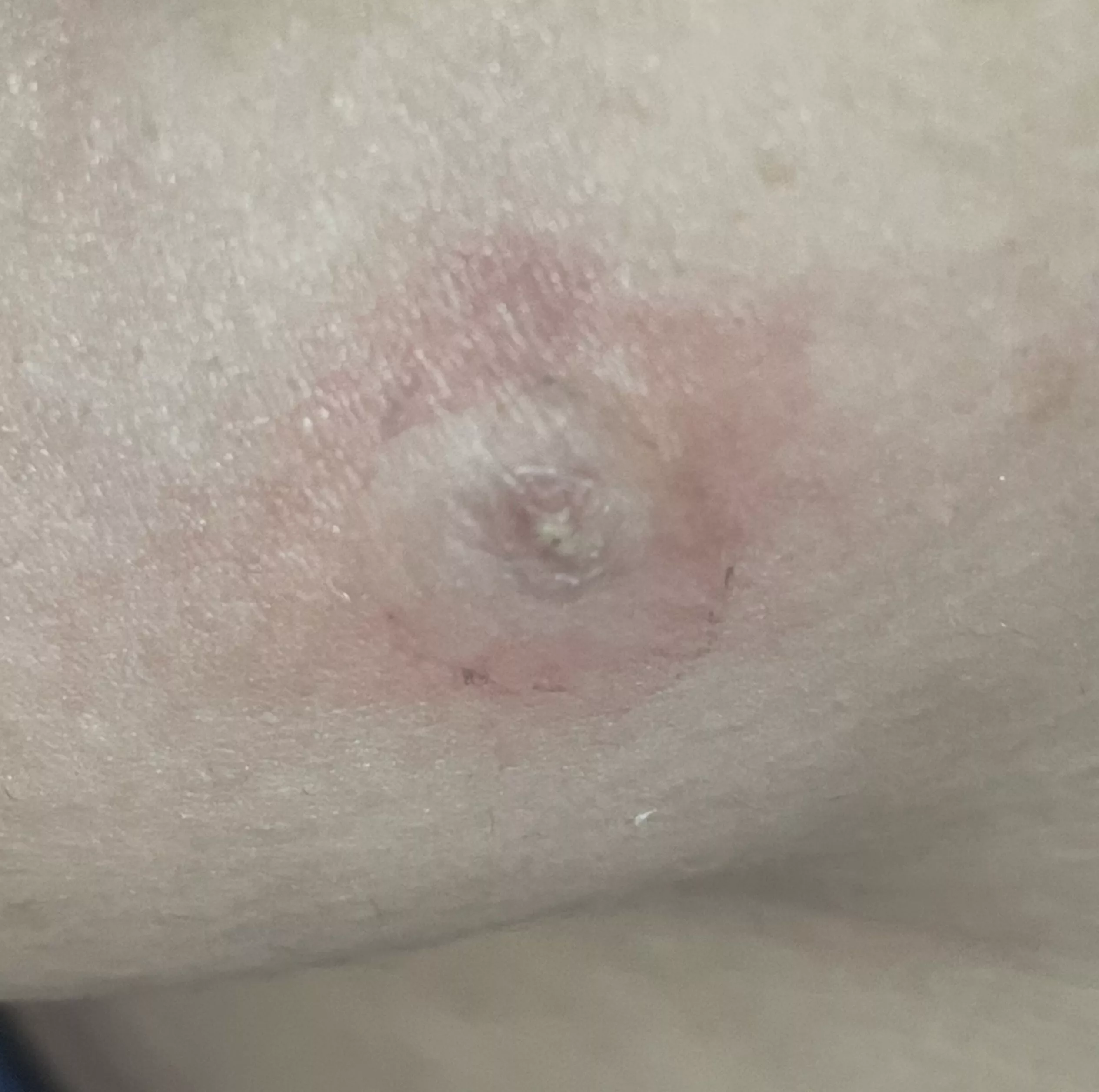 I wanna pop this so bad but I was taught not to pop pimples…