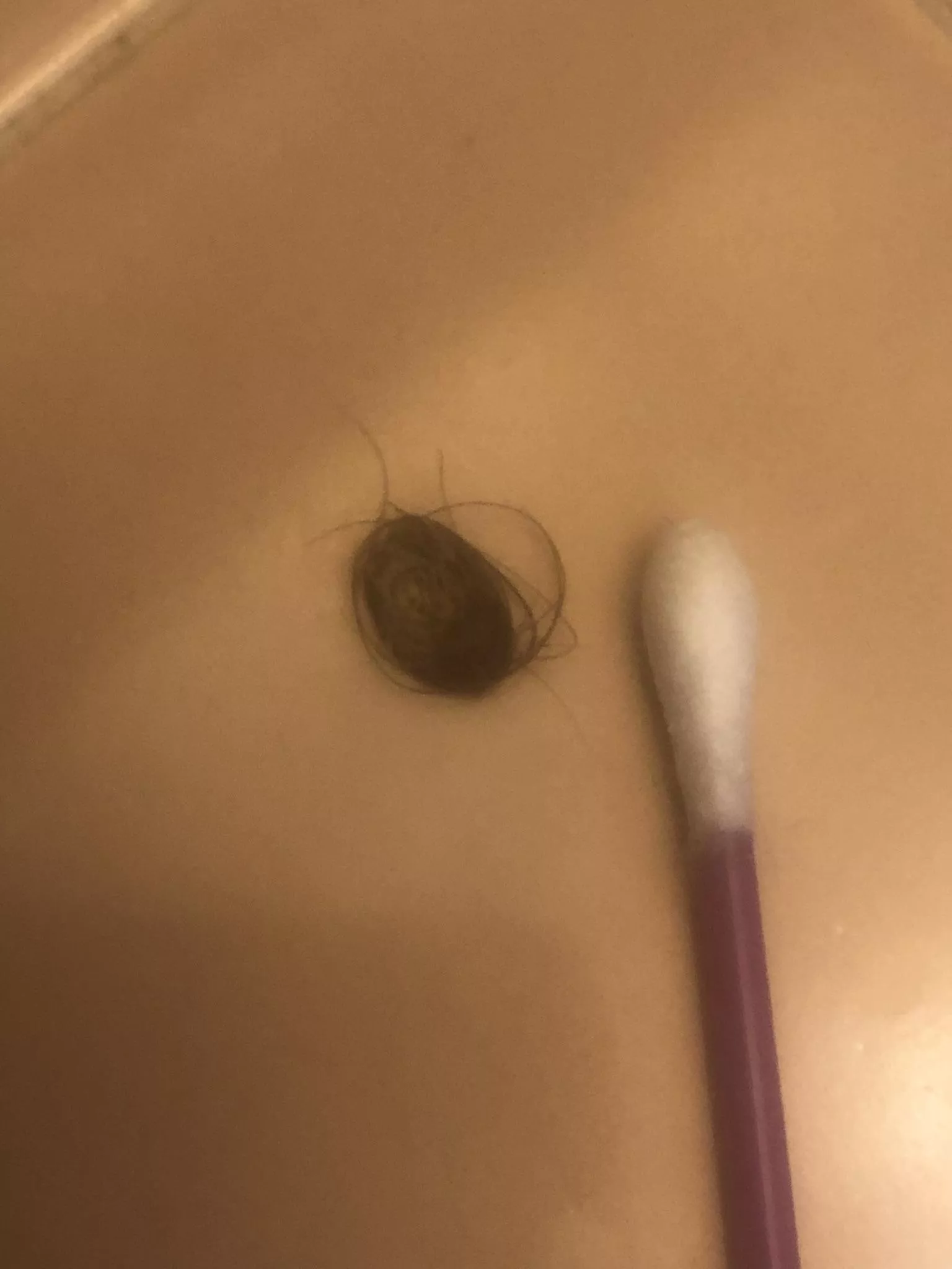 I've had an ingrown hair for years. Finally got it out. Q-Tip for scale.