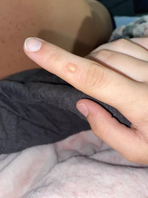 [pic] forbidden pop: blister from a grease burn on my finger 🥲