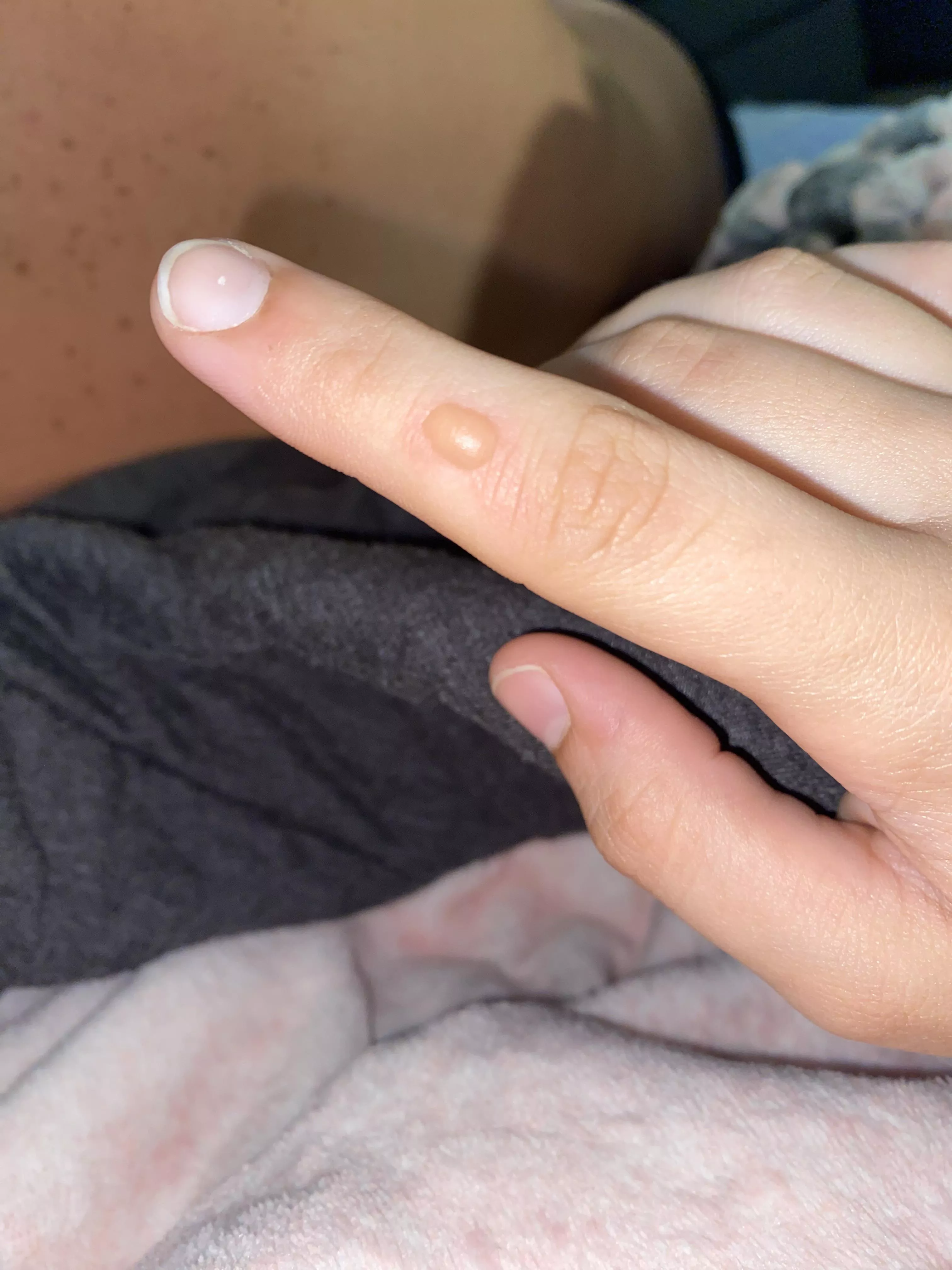 [pic] forbidden pop: blister from a grease burn on my finger 🥲