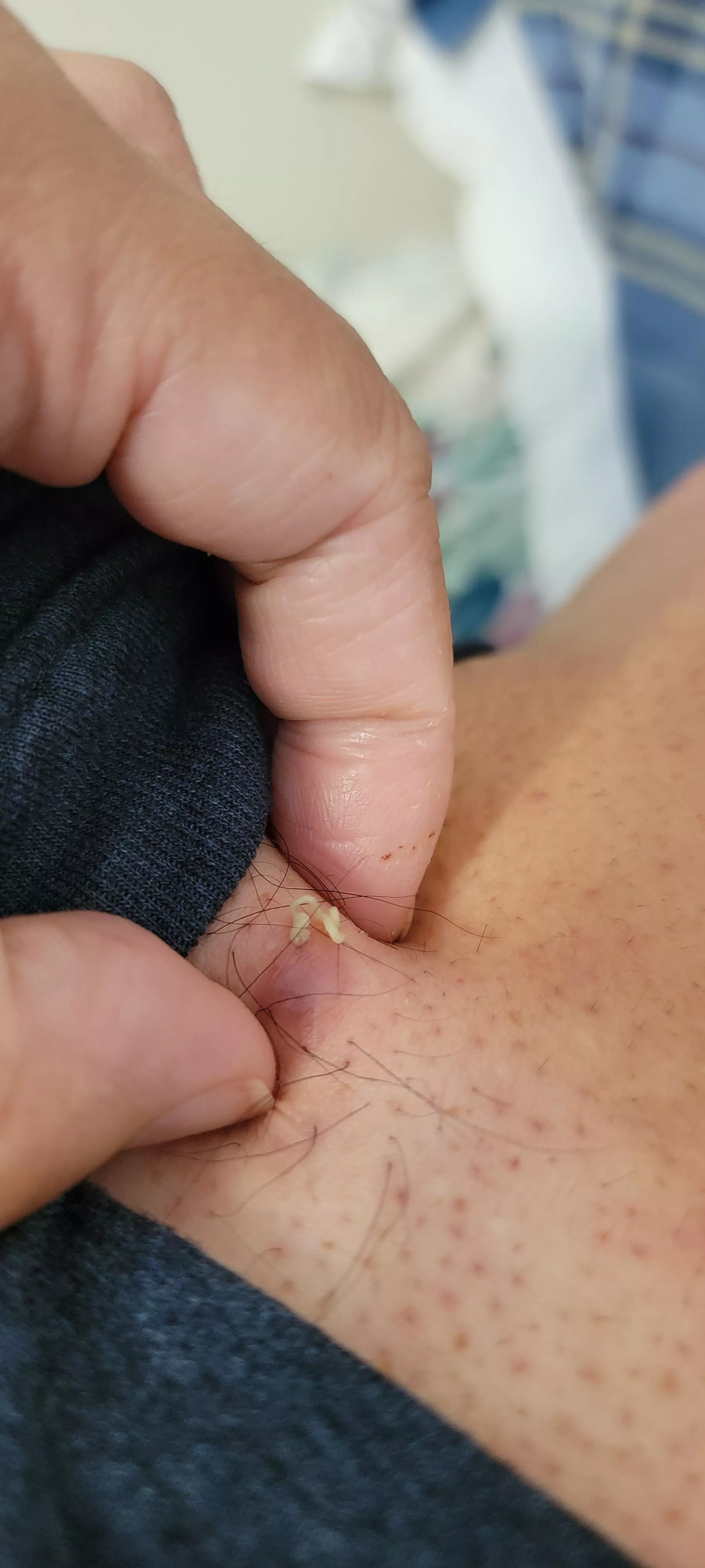 Had this cyst lanced 3 months ago. Girlfriend just gave it a squeeze again. 🤢