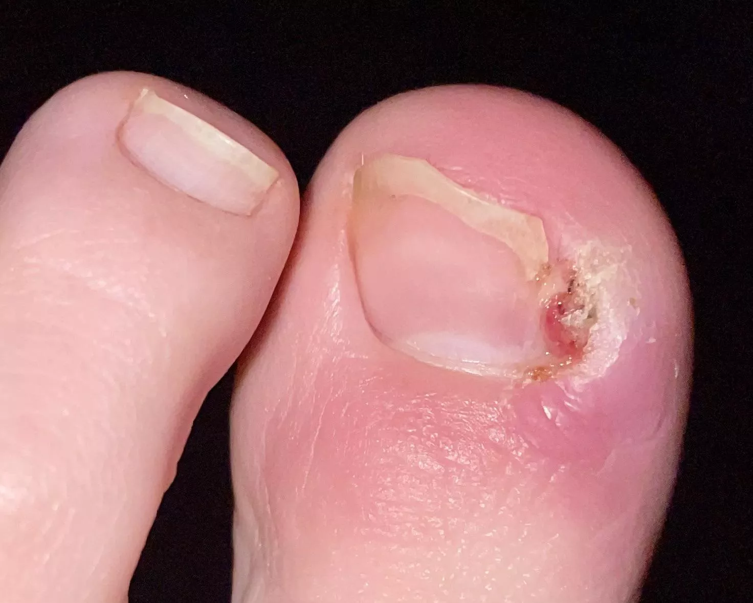 Update! Still waiting to see a podiatrist. The doctor I saw gave me antibiotics and said it’ll heal itself 😂 I guess I’ll do DIY surgery AGAIN. It’s still very sore and swollen so it’s really hard to dig out,but it does seem a bit better than 