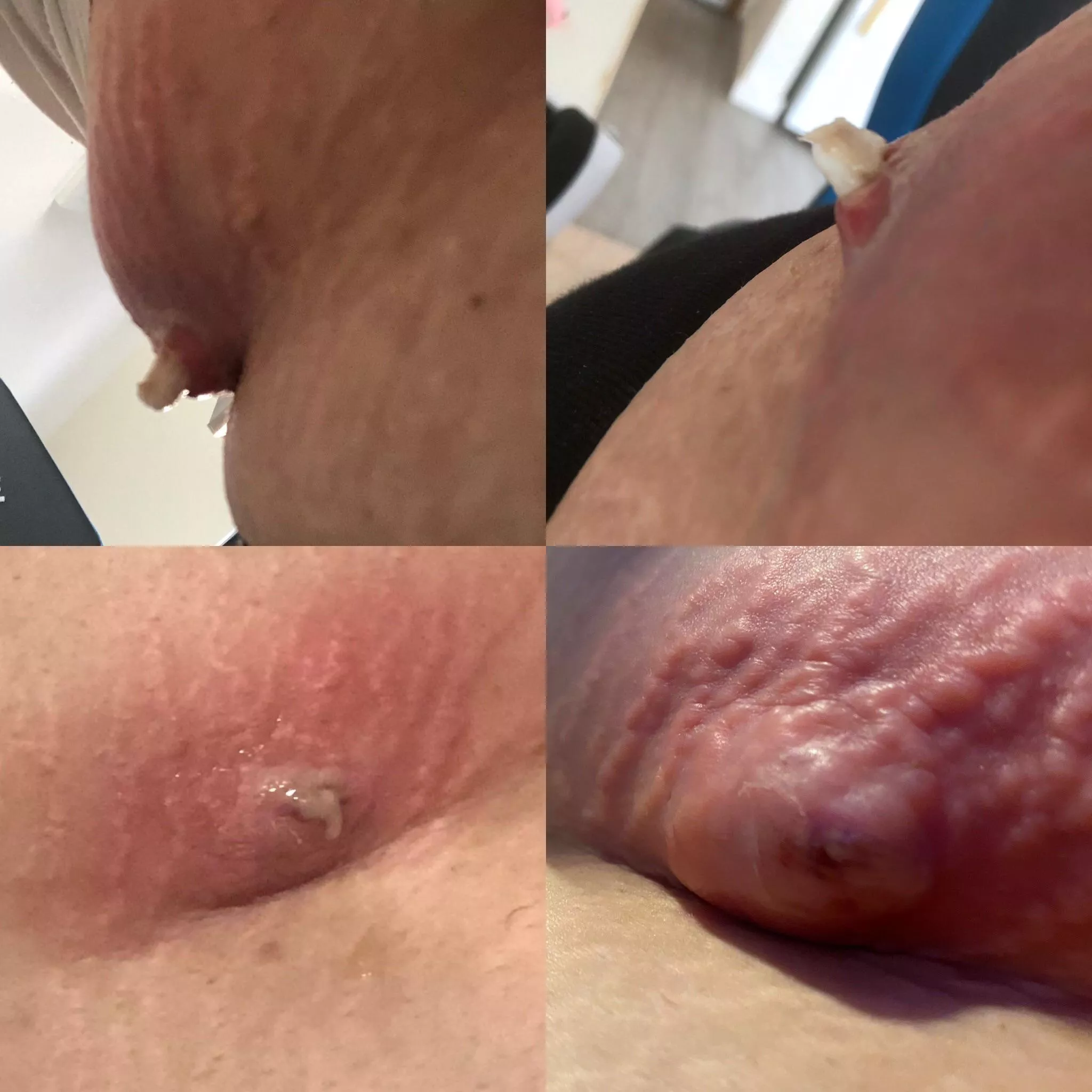 the first 2 are from today, the 4th photo was when it was at its peak and i was screaming from the pain