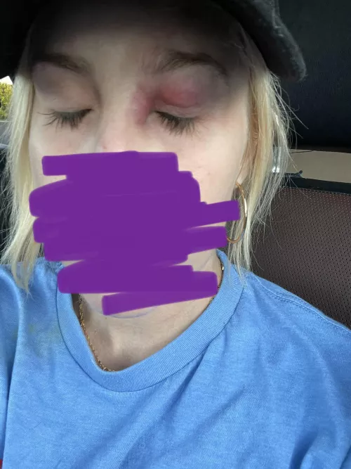Eye cellulitis frustrated