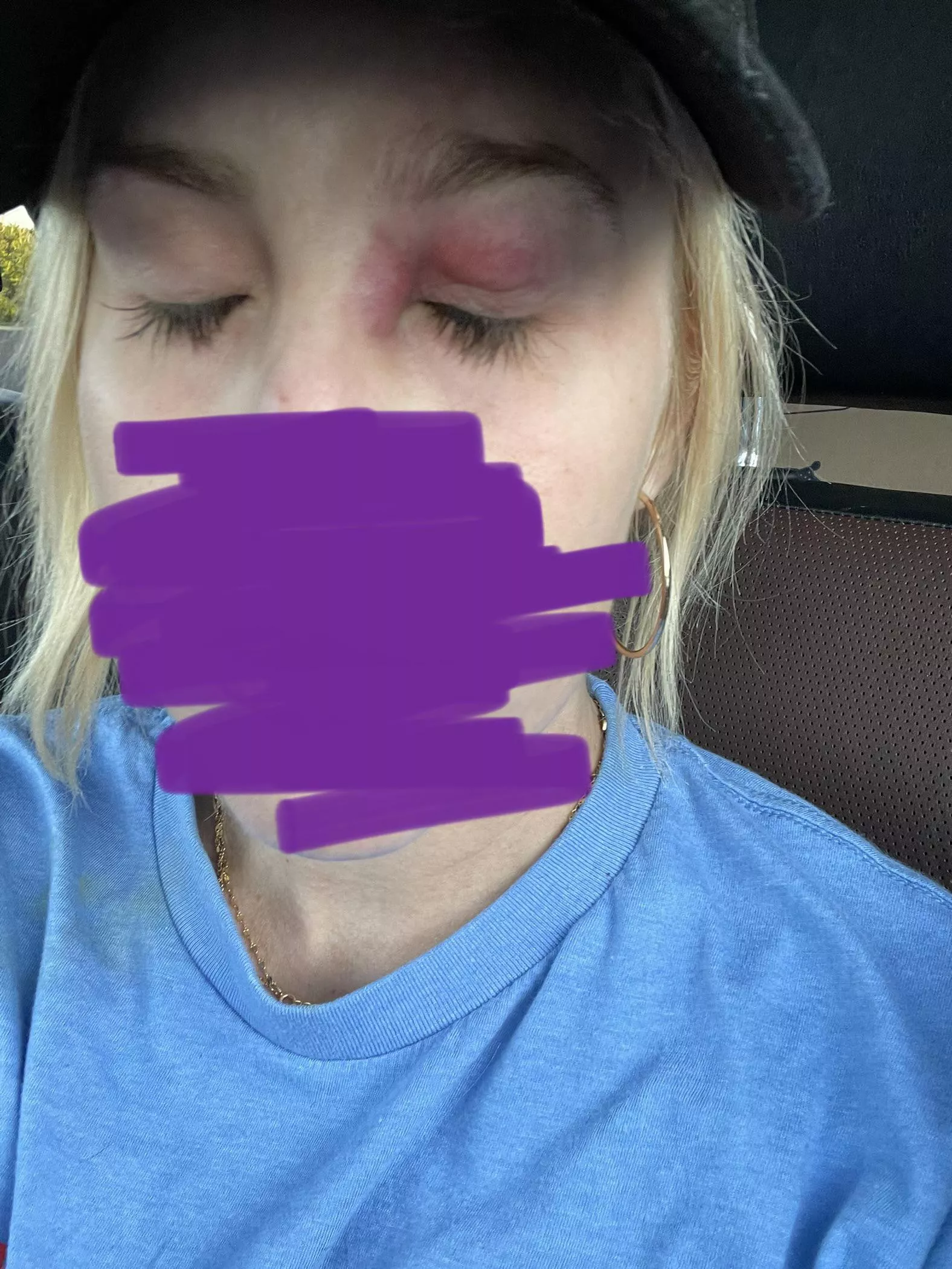 Eye cellulitis frustrated