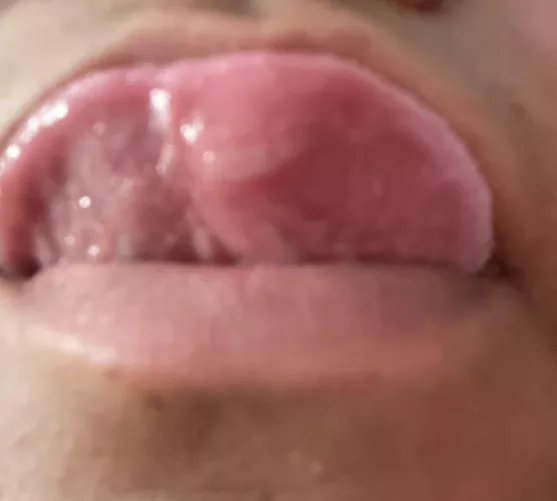 I had thyroid surgery yesterday and idk if I bit my tongue…