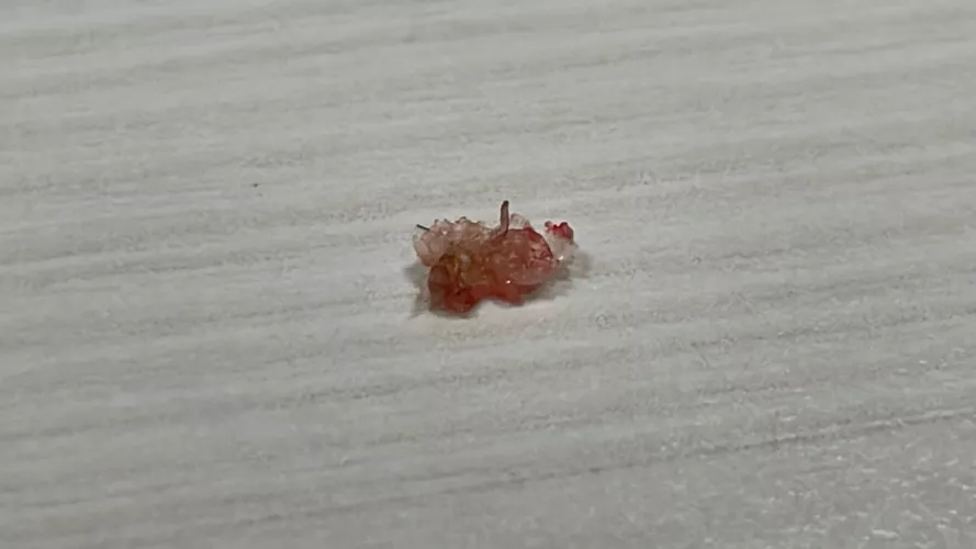 Popped the scab at the back of my head