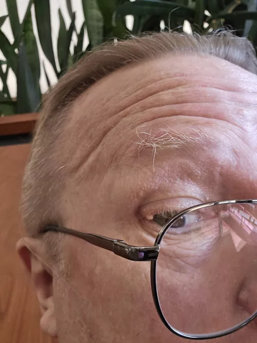 Stye Update, do sending me to specialist Monday. Plugged eyelash folicle.