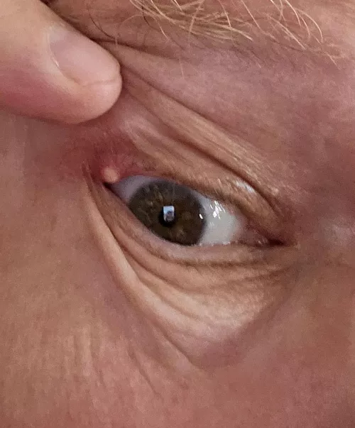 The Stye in my Eye, Having a Doctor look at it tomorrow.