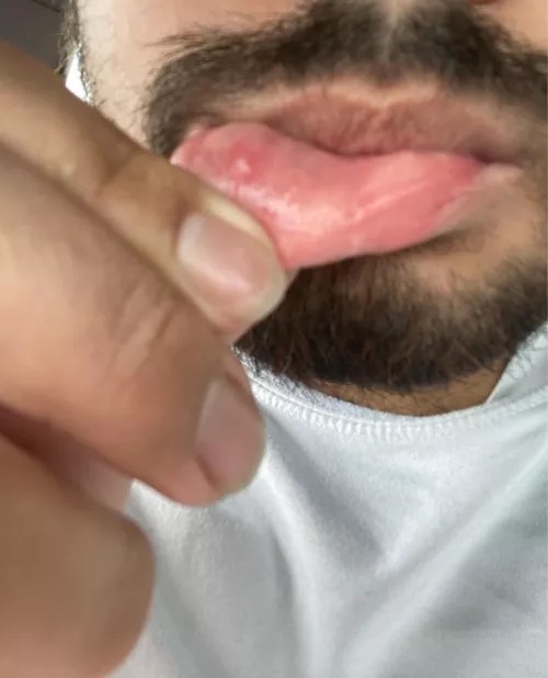 Werid bump on lip I have a habit of biting lip at work but doesn’t look like a Oral Mucocele it’s very white