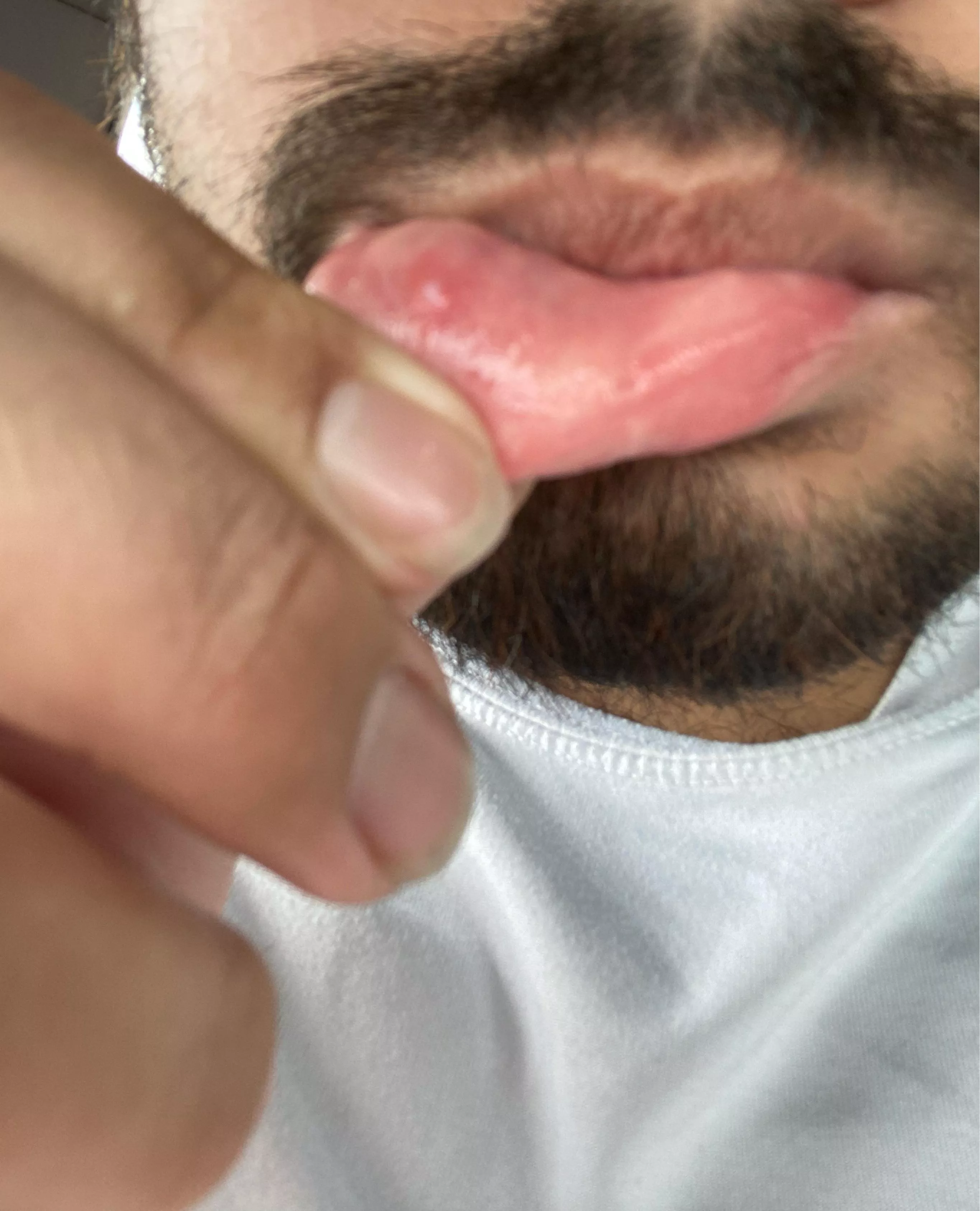 Werid bump on lip I have a habit of biting lip at work but doesn’t look like a Oral Mucocele it’s very white