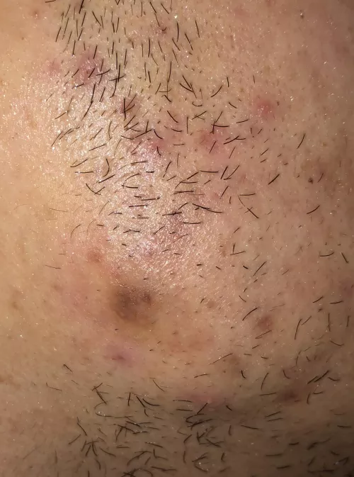 Can a cyst/pimple/papule pop under the skin?