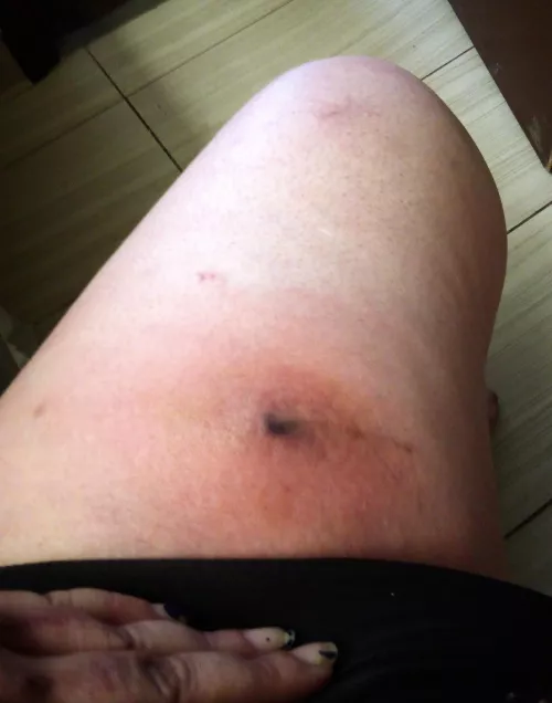 Angry looking abscess is coming to a head, think it's gonna blow today