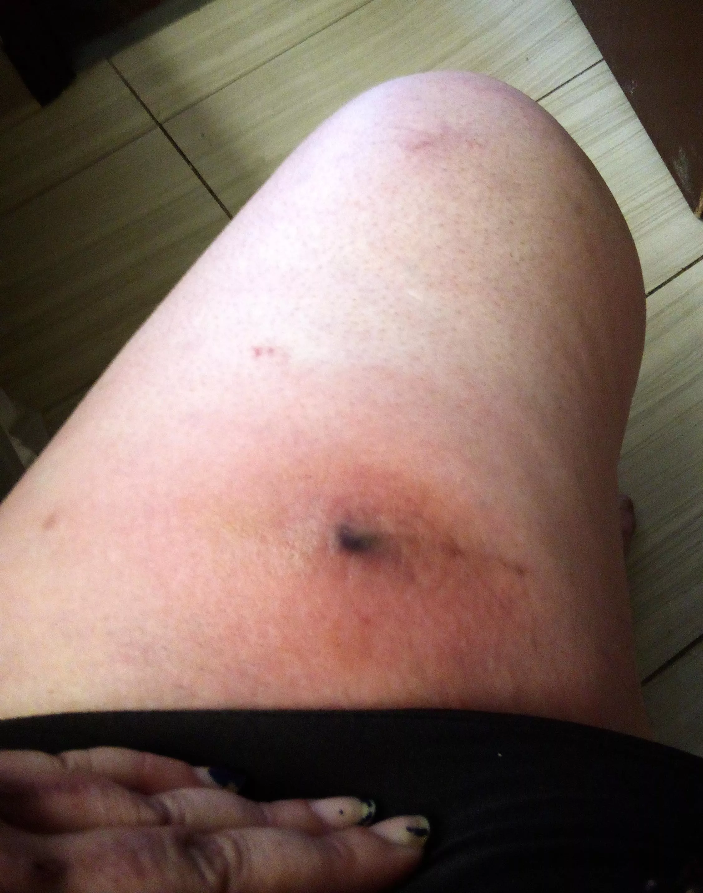 Angry looking abscess is coming to a head, think it's gonna blow today