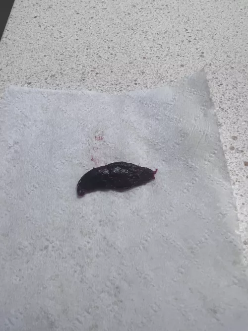 Blood clot from a thrombosed hemorrhoid