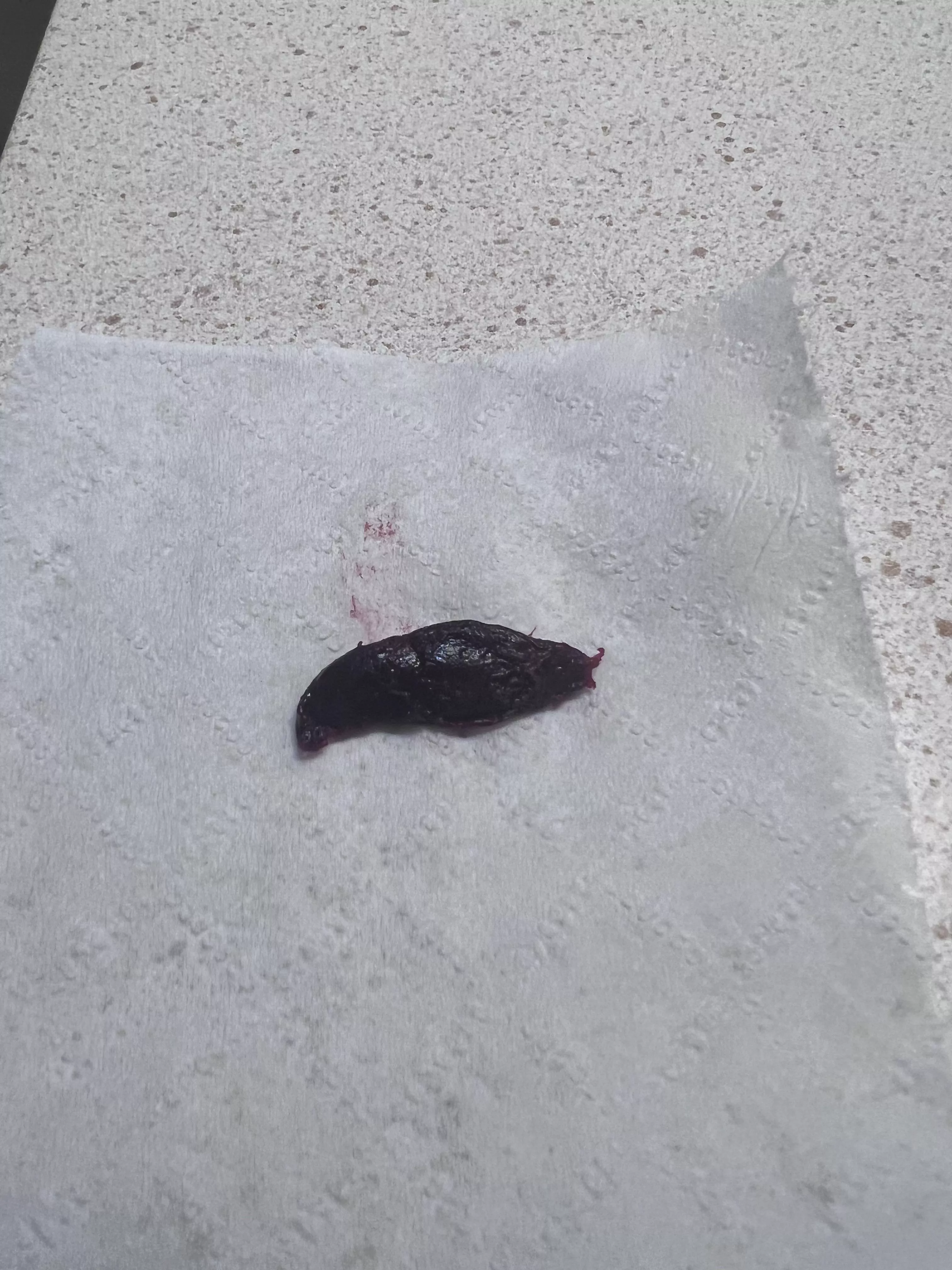 Blood clot from a thrombosed hemorrhoid