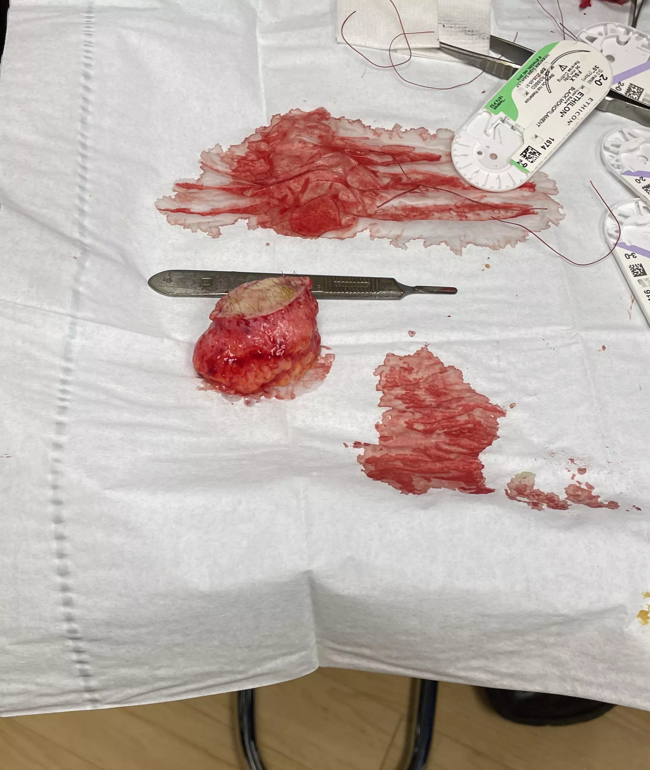 Sebaceous cyst removed