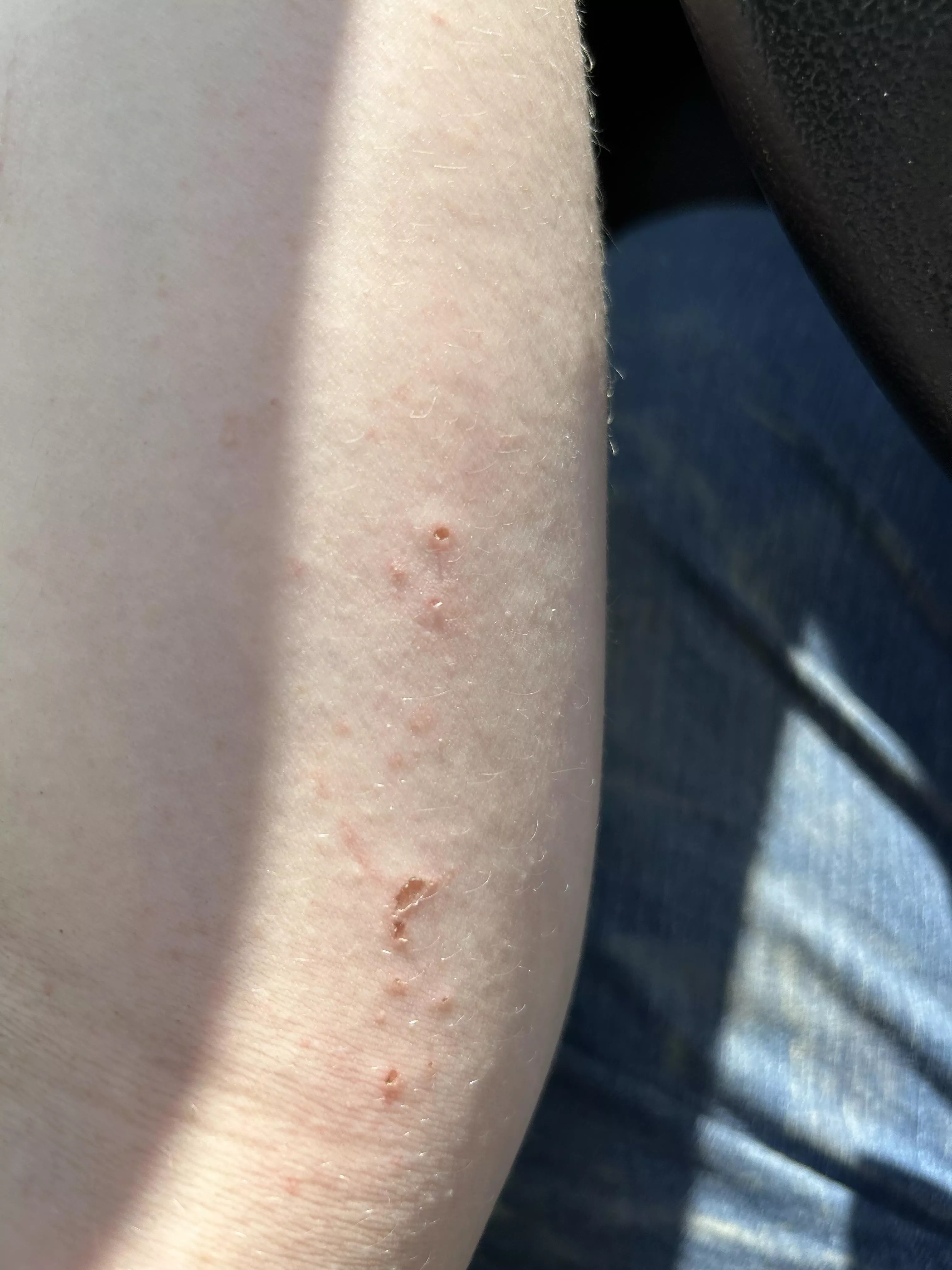 This is why you wear a welding jacket