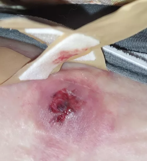 Wtf?! Blood blister/idk wth..I butchered it though. Size of a nickel extended off of me