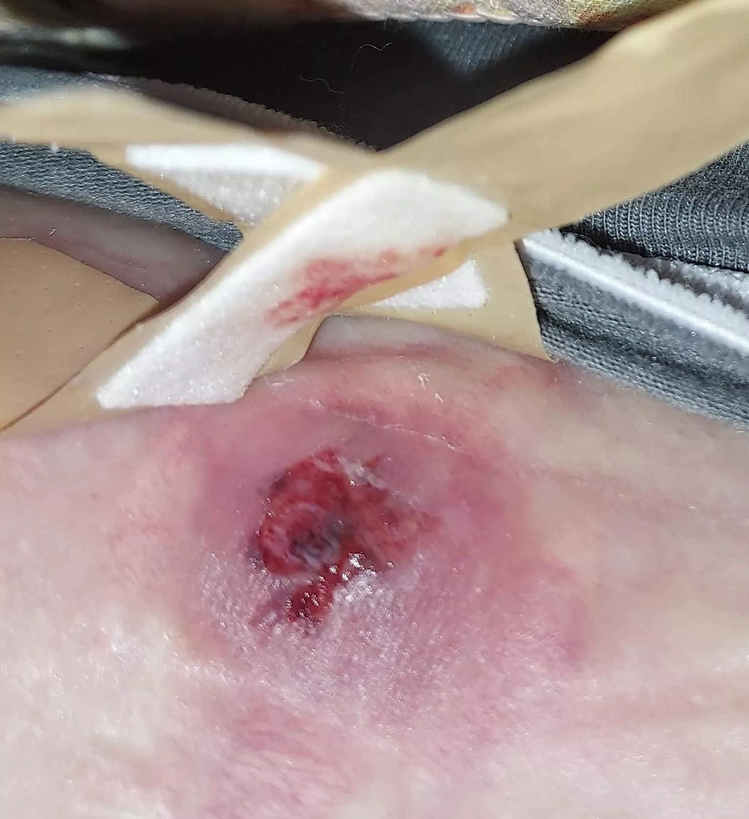 Wtf?! Blood blister/idk wth..I butchered it though. Size of a nickel extended off of me