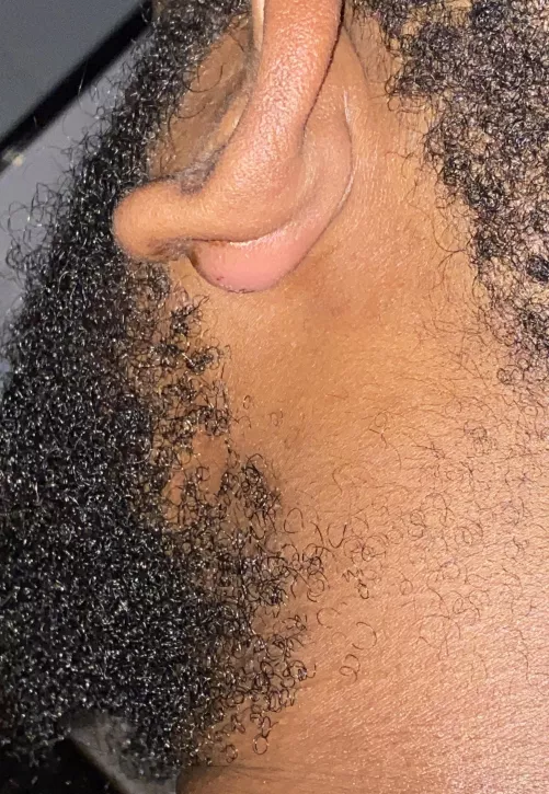 Boulder forming on my bf’s ear