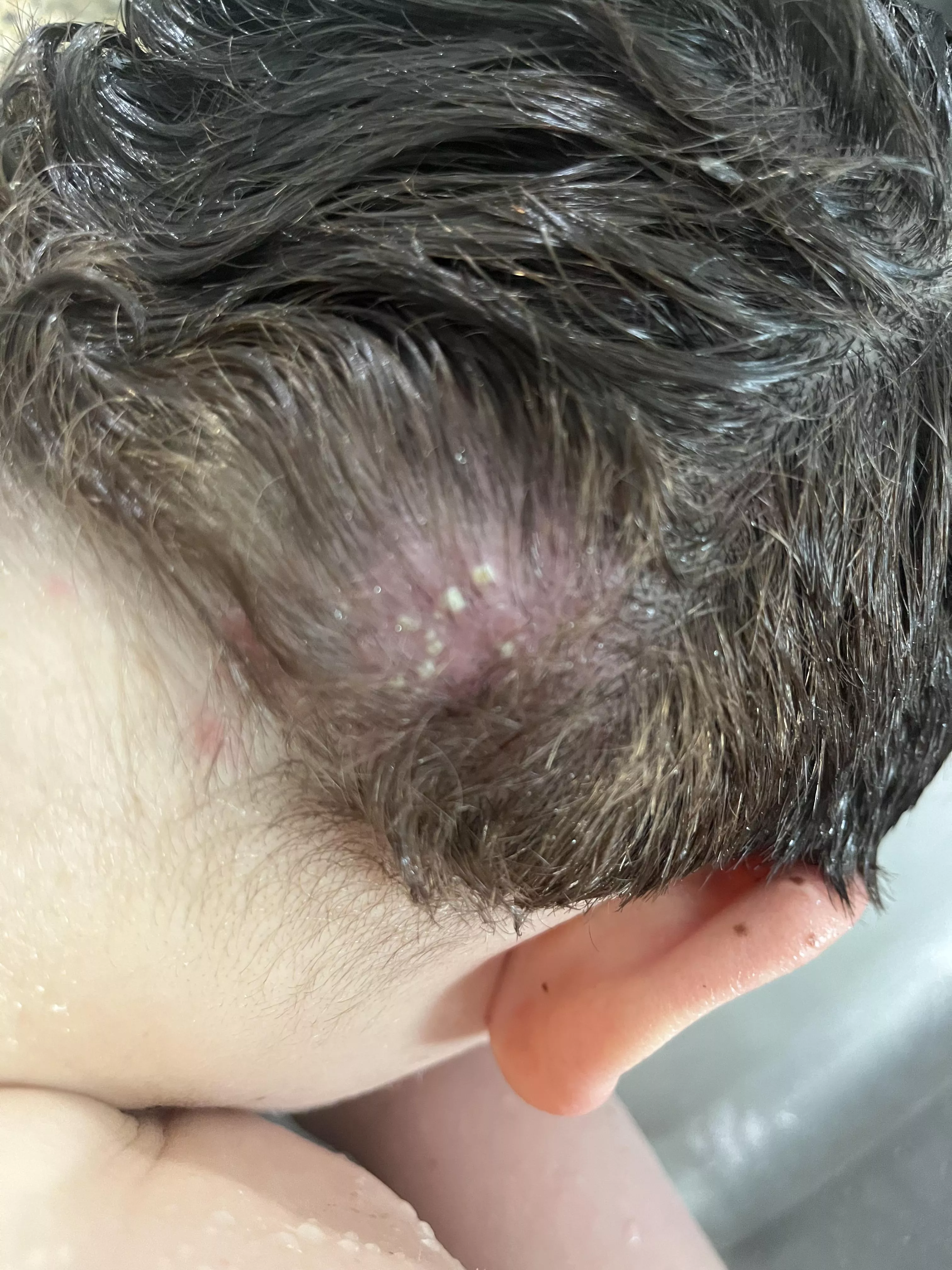 Forbidden pops. My sons psoriasis breakout