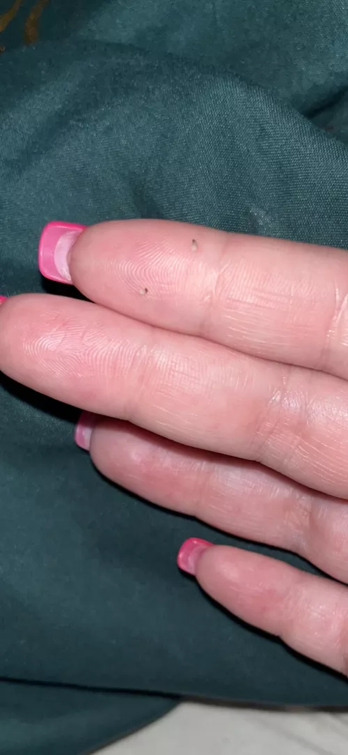 A couple of nice sized blackheads I just squeezed out of the inside of my thigh. Definitely regret not filming them.