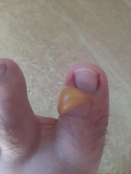 Mosquito bite on toe