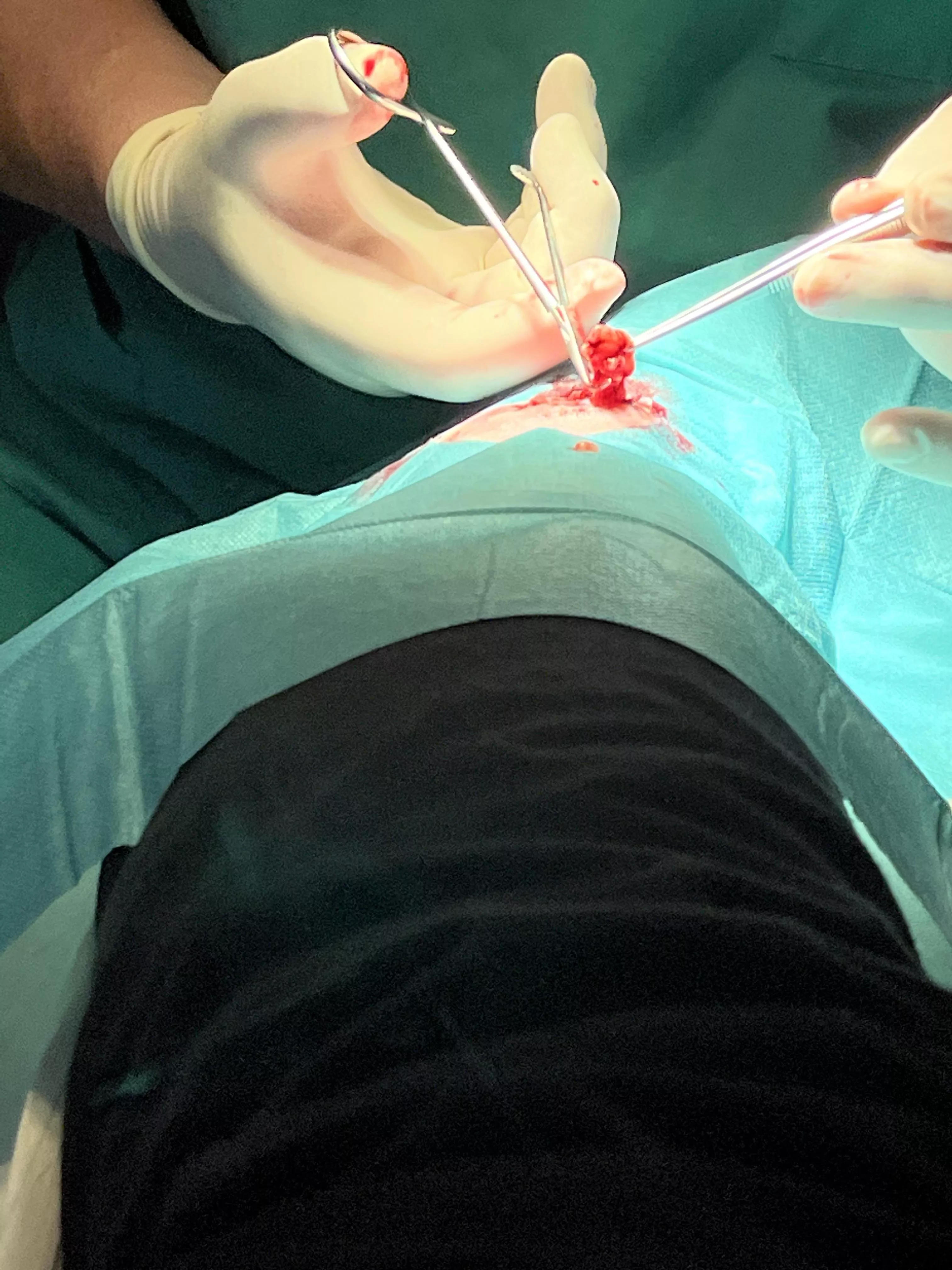 Non-poppable ankle lipoma (it fell apart and came out in pieces)