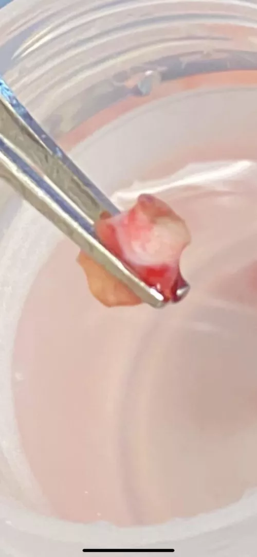 The cyst that was in my armpit 😃