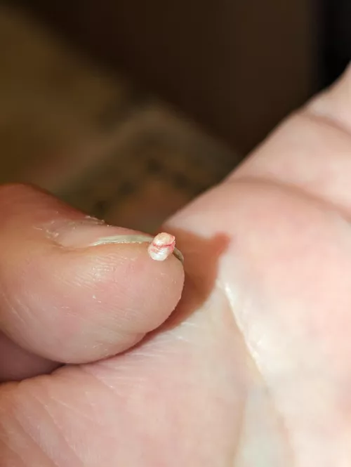 Labia majora cyst I got out this morning