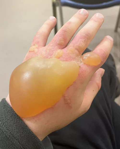 Giant Blister - I’ll leave you to imagine the pop