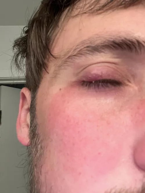 Little white bump on eyelash line with stye