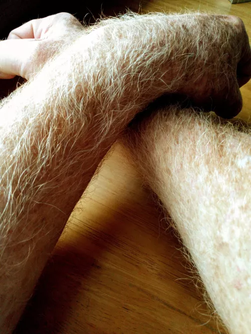 I hated being a ginger. So glad when the sun bleached it blond