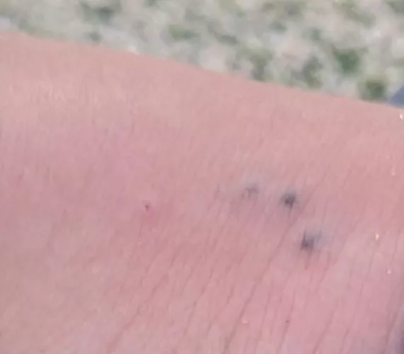 I think my sister stepped on a sea urchin on a beach. We soaked the foot in hot water for now. What should we do?